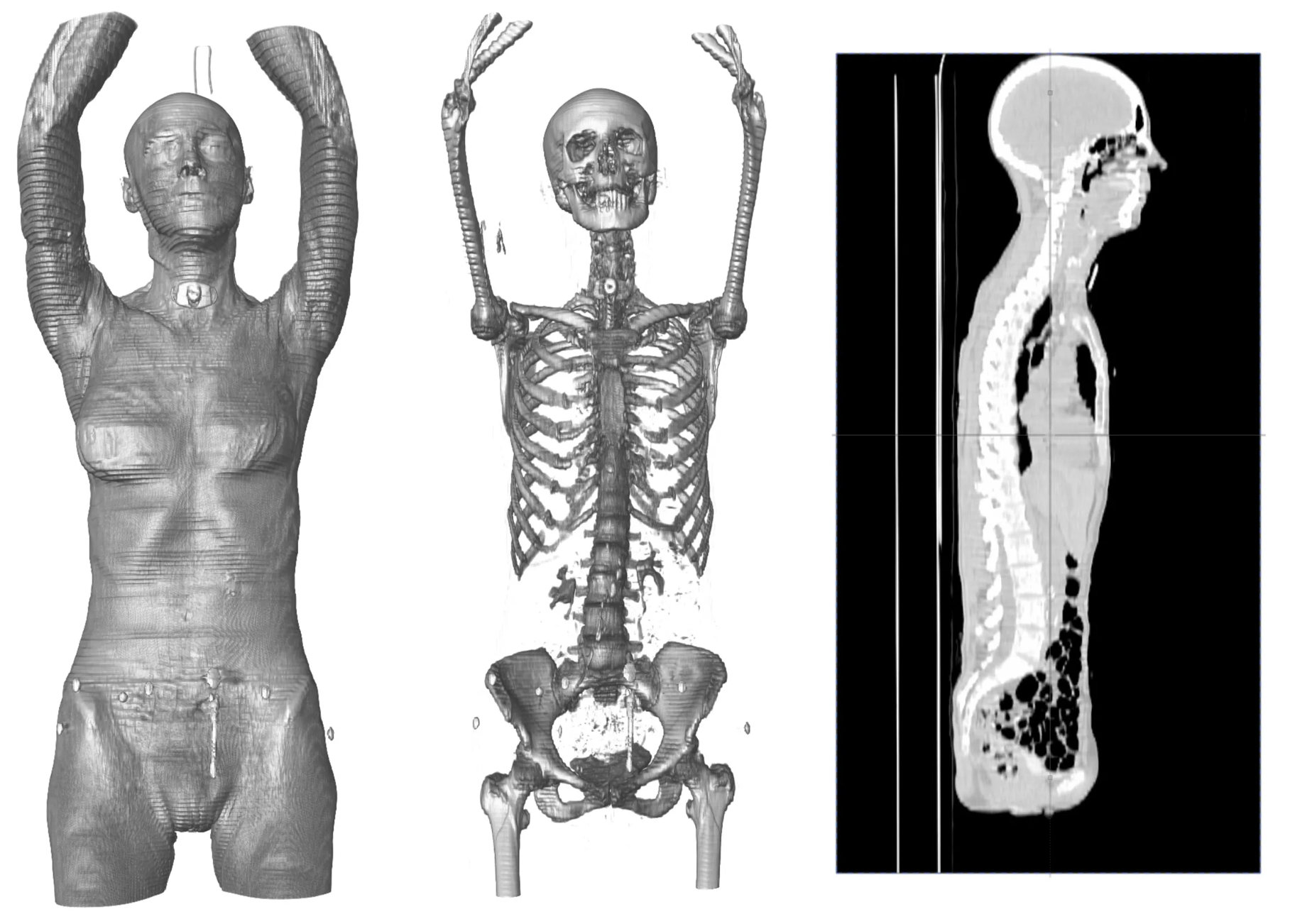Full Body CT Scan - Female