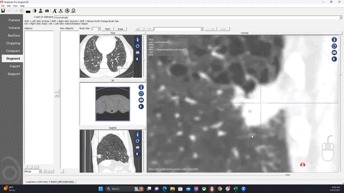Lung Tumor Segmentation from CT