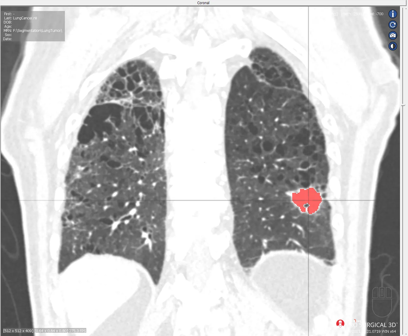 CT Lung Cancer
