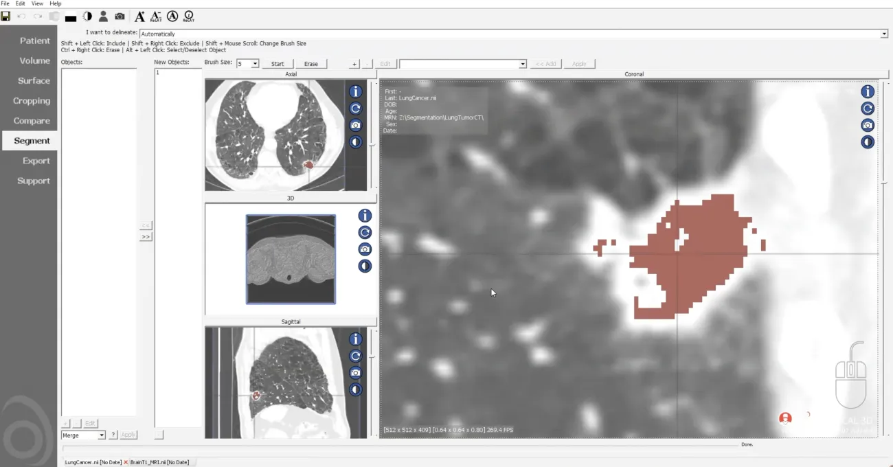 Lung Tumor Segmentation and Annotation
