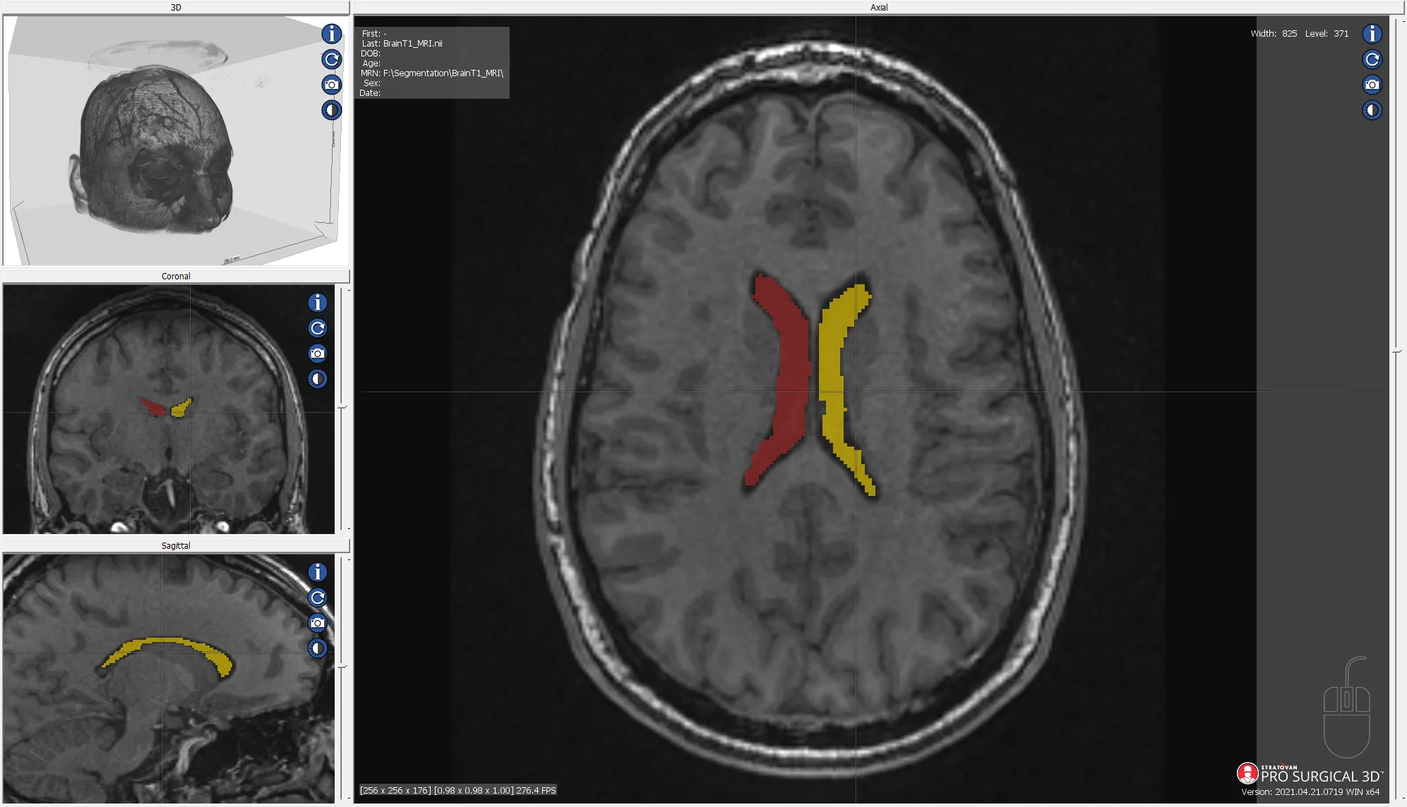 MRI segmentation of human brain ventricle