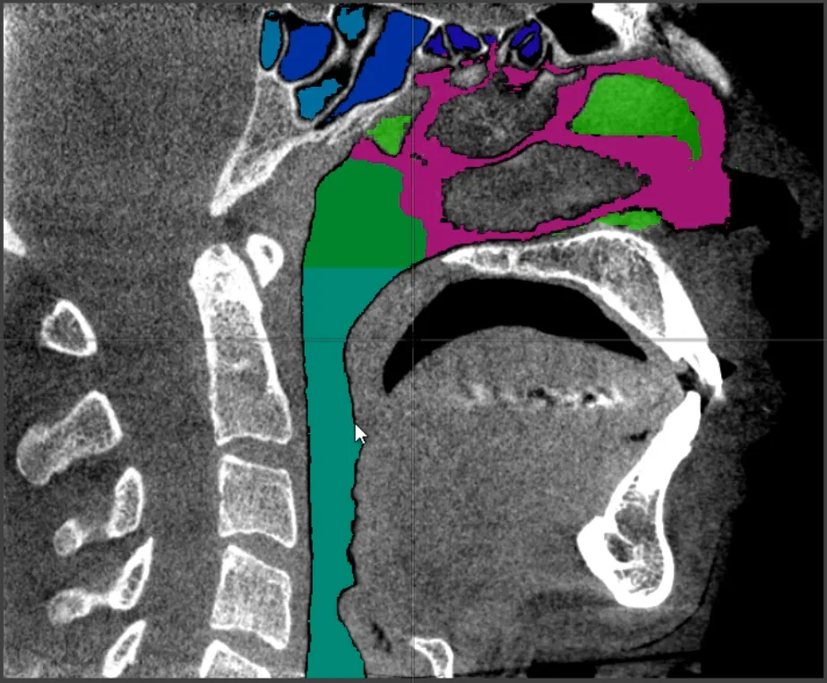 X-ray Cone Beam CT (CBCT) sagittal slice view of segmentation of human airway anatomy