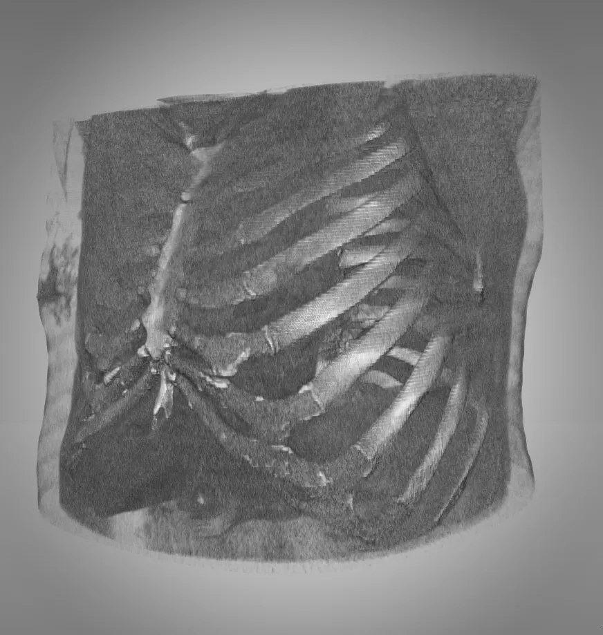 3D Chest X-ray CT